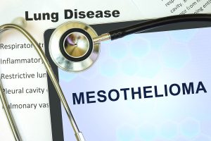 Stages and Diagnostic Process of Mesothelioma